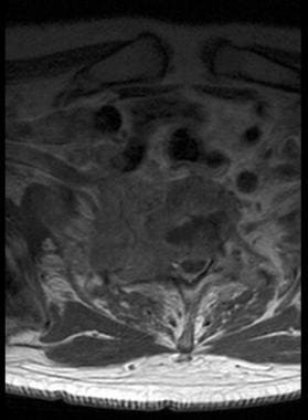 Pancoast tumor. Axial T1-weighted image shows cord