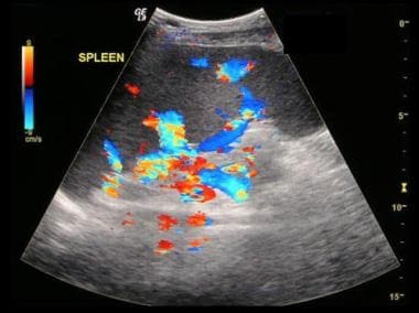 Budd-Chiari syndrome: The last of six ultrasound i