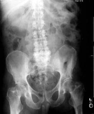 Abdominal radiograph of acalculous emphysematous c