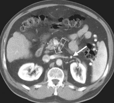Splenorenal shunt. A collateral vessel passes caud