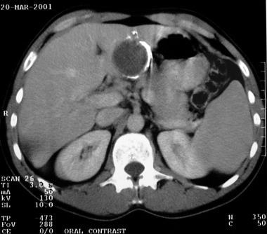 This transaxial CT scan of the liver shows a calci