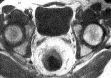 Axial MRI scan of a T3a rectal carcinoma, revealin