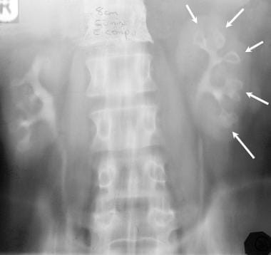 Excretory urography in a 53-year-old man with anal