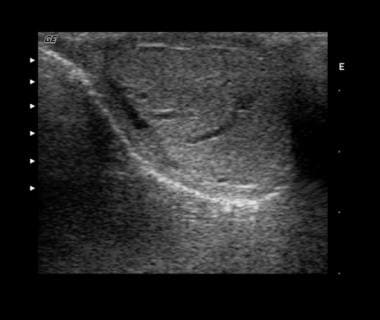 Sonogram depicting a combination of an intratestic