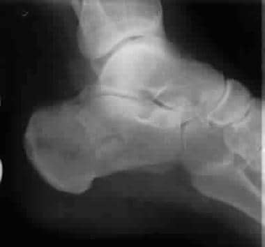 Calcaneus, fractures. Essex-Lopresti tongue-type c