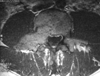 Contrast-enhanced axial T1-weighted magnetic reson