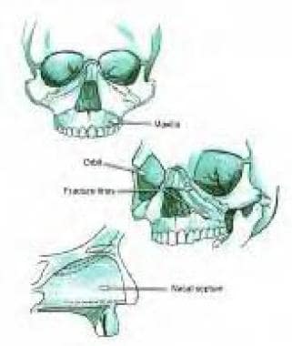 le fort fracture x ray