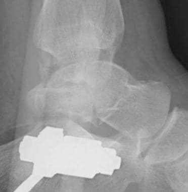 Talar body fracture, lateral radiograph (same pati