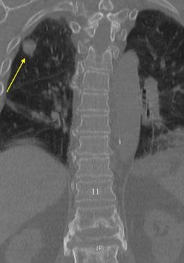 Coronal CT of the Thoracic and Upper Lumber Spine.