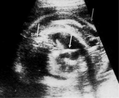 Transverse ultrasonogram of the thorax in a fetus 