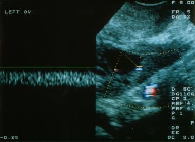 Color Doppler ultrasonogram shows low impedance fl