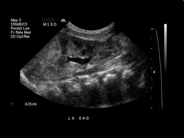 Longitudinal view of the left kidney in the same p