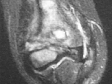 Fat-suppressed T2-weighted coronal MRI shows that 