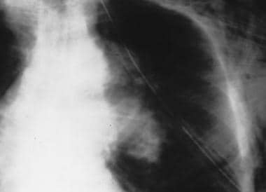 Aorta, trauma. Chest radiograph shows an isthmus t