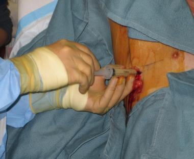 Best Practices: Tube Thoracostomy Insertion