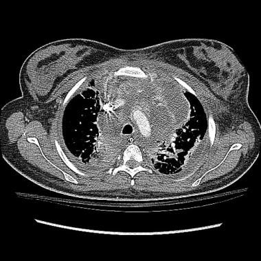 Axial CT image of a 16-year-old adolescent with gr
