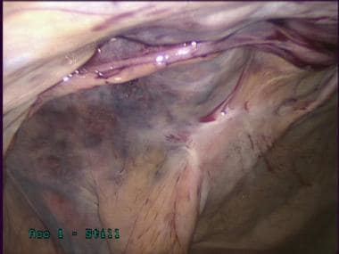 Laparoscopic inguinal hernia repair (TEP)