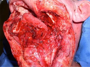 Full-thickness resection of the left mandible body