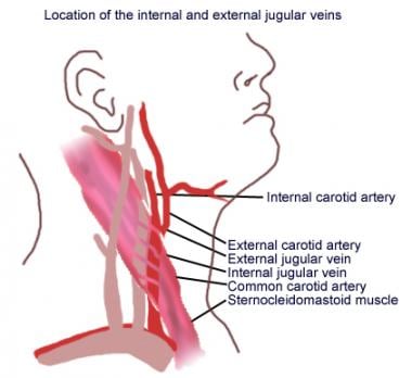 Central Venous Access Via External Jugular Vein Background