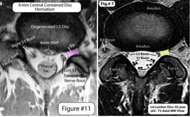 Appearance of lumbar disk herniation on MRI.