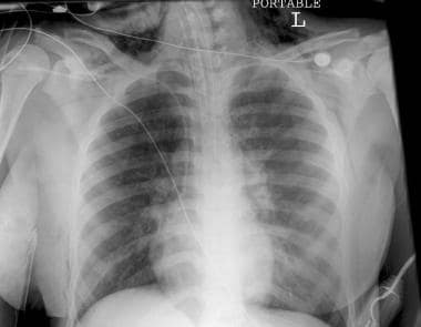 The chest radiograph is taken from an adolescent g
