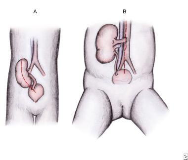 Incisions used for kidney transplantation. (A) Gib