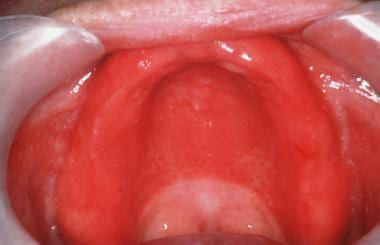 mild oral candidiasis