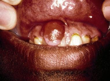 Pyogenic granuloma on the facial gingiva of teeth 