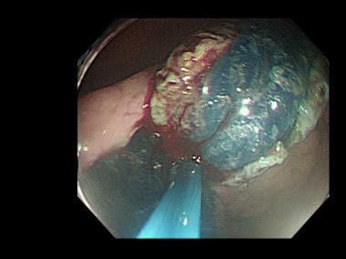 Endoscopic submucosal dissection (ESD). Submucosal