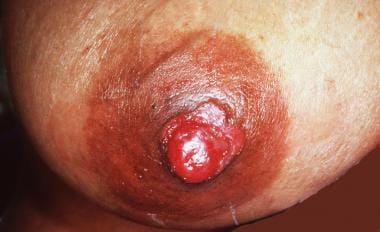Biopsy-proven Paget disease involving nipple of 56