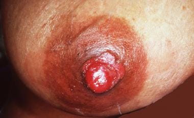 Gross image demonstrating right breast with erythematous areas