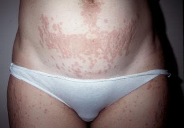 Papules within prominent striae distensae. Courtes