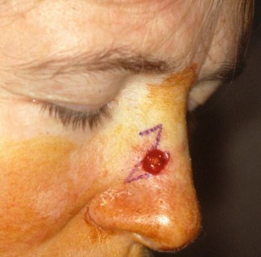 Post-Mohs surgical defect over the right nasal sid