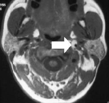 轴向t1加权MRI显示新月形信号
