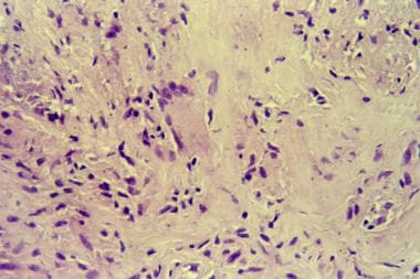 Hematoxylin and eosin stain showing caseation in t