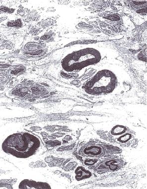 Electron micrograph of the peripheral nerve of a p
