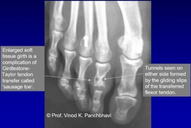 Hammertoe Deformity Treatment & Management: Approach Considerations,  Medical Therapy, Surgical Therapy