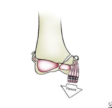 Medial condyle fracture caused by traction through