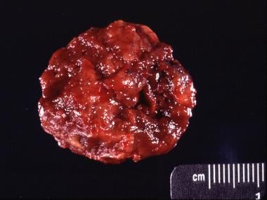 Gross specimen of  same giant cell tumor in the di
