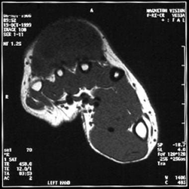 T1-weighted MRI depicts a synovial sarcoma of the 