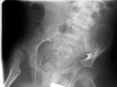 Spinal muscle atrophy. Anteroposterior radiograph 