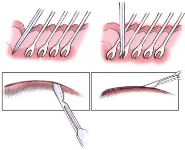 Direct brow lift. Beveling the incision. 