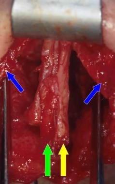 This intraoperative photo demonstrates proper plac