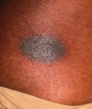 Hyperpigmented fixed drug eruption on the hip of a