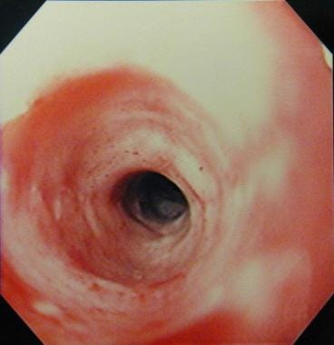 Esophageal stricture. Endoscopic appearance of the