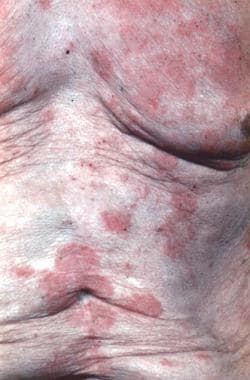 Cutaneous T-Cell Lymphoma Clinical Presentation: History, Physical