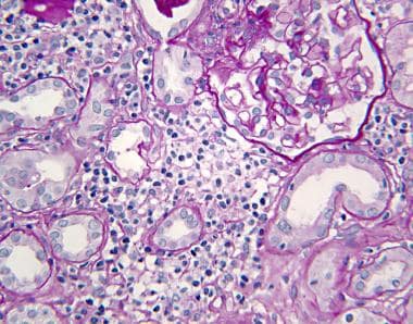 Tubulointerstitial nephritis: Kidney biopsy reveal