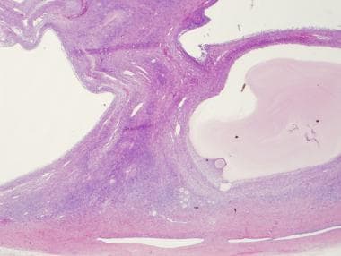 Low power, H and E of an ovary containing multiple