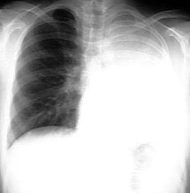 Complete atelectasis of the left lung. Mediastinal