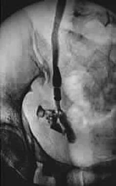 Retrograde urethrogram showing a leak in the dista
